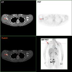 Diagnosing cancerous and non-cancerous breast tumours